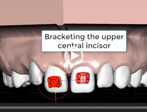 Orthodontic Bracketing Introduction: Central Incisors (Video)