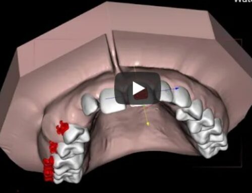 Orthodontic Bracketing Introduction (Video)