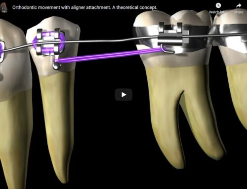 Aligner and Tooth Movement (Video)