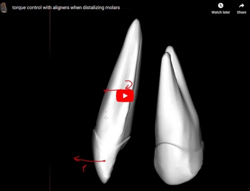 Incisor Control when Distalizing Upper Molars (Video)