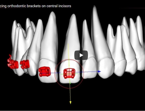 Orthodontic Bracketing (Video)