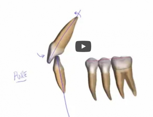 Pure Intrusion of Lower Incisors (Video)