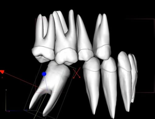 Molar Uprighting with the Straight Wire System